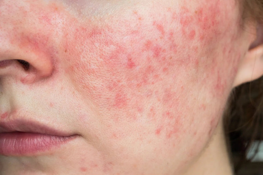 woman with rosacea on her cheek.