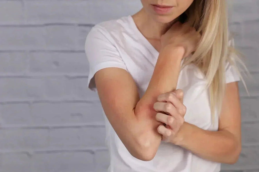 Red Light Therapy for Eczema: How It Might Help - Mito Red Light