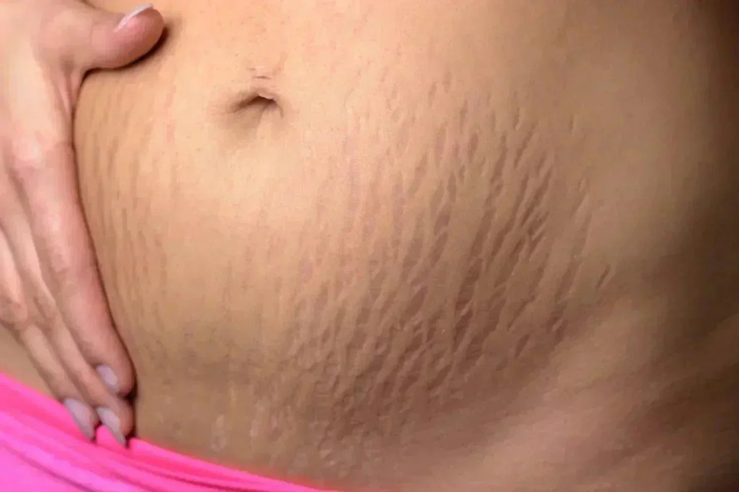 Red Light Therapy for Stretch Marks: Can it Help?