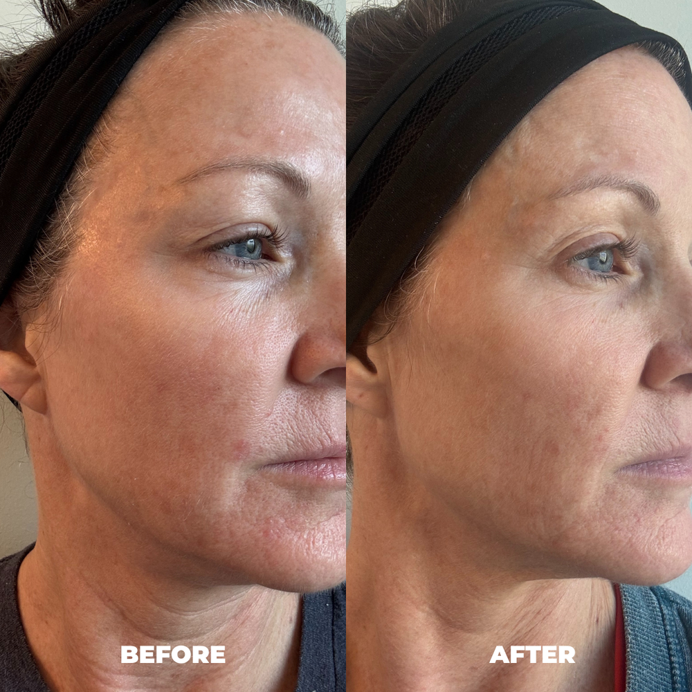 Anna T MitoGLOW LED face mask before and after result for skin tone and texture