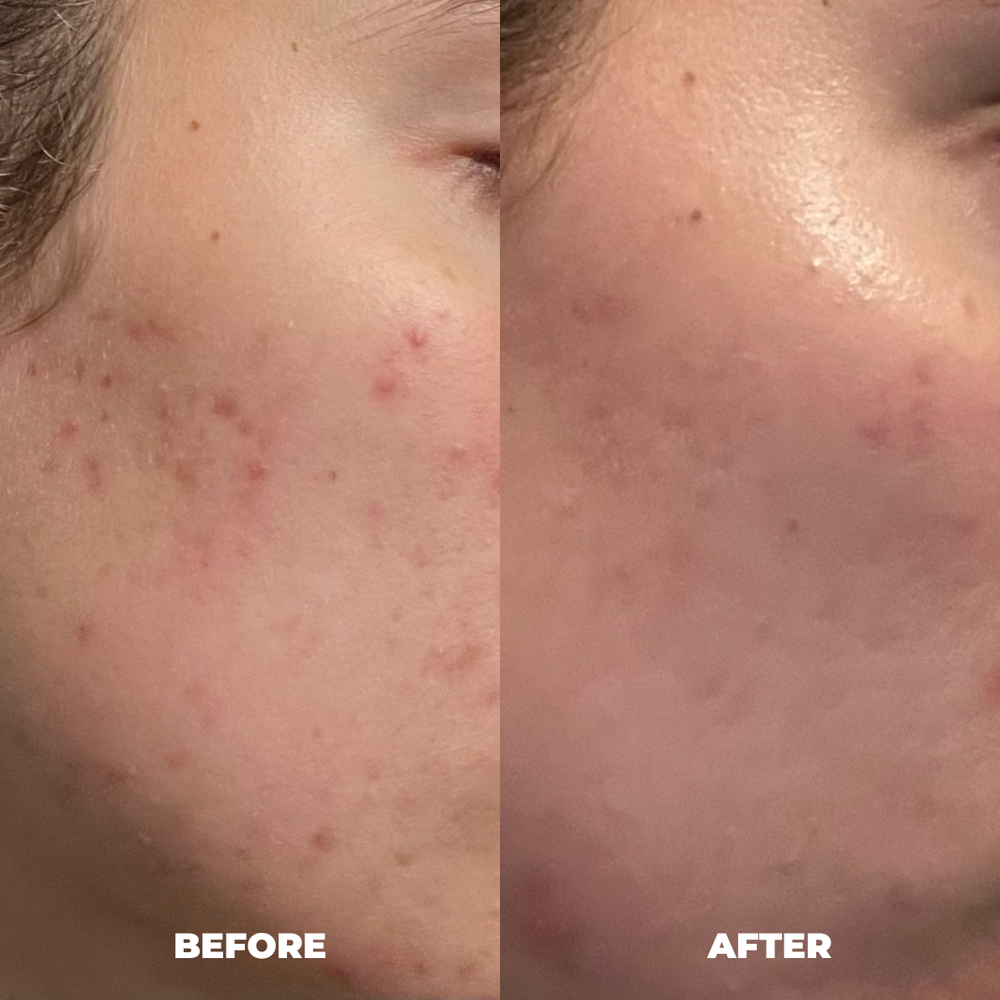 Ashleigh A MitoGLOW before and after LED face mask result for skin appearance