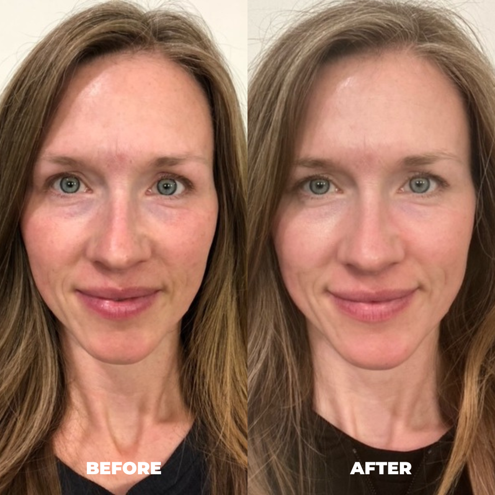 Jessie L MitoGLOW LED mask before and after result for LED face mask comparison shoppers