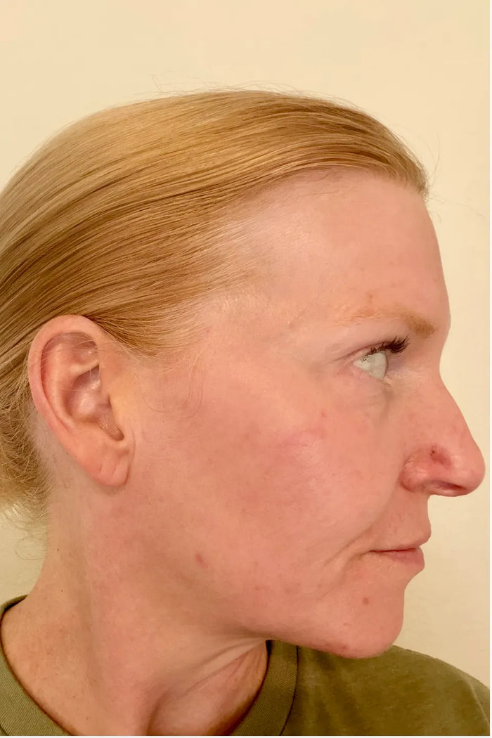 Rebecca H. before